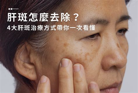 額頭黑斑|一次解析曬斑、肝斑、雀斑、顴骨母斑等皮膚黑斑原因…